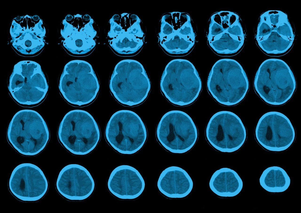 What is Meningioma? Symptoms, Diagnosis, & Treatment